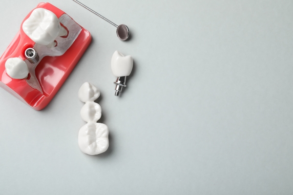 Key Differences: Dental Bridges Vs Dental Crowns
